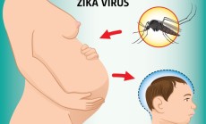 "Zika virusas"