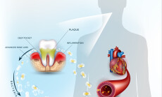 Gum,Disease,Inflammation,Bacteria,Can,Enter,In,To,The,Blood