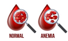 Iron,Deficiency,Anemia.the,Difference,Of,Anemia,Amount,Of,Red,Blood