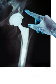 X-ray,Of,The,Pelvis,Endoprosthesis,,The,Socket,Of,The,Hip
