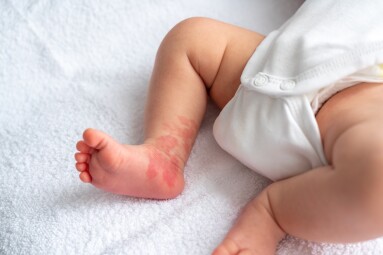 Hemangioma,Red,Birthmark,On,The,Leg,Of,Newborn,Baby
