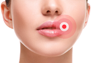 Close,Up,Of,Female,Lips,Affected,By,Herpes,Virus