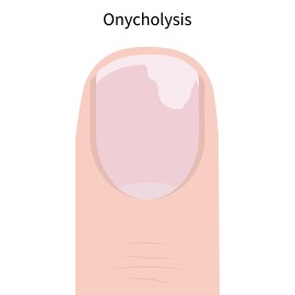 Onycholysis.,Nail,Diseases.,Complications,After,Using,Gel,Polish.,Vector,Illustration