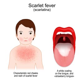 Scarlet,Fever.,Signs,And,Symptoms,Of,Scarlatina.,Child,With,Rash