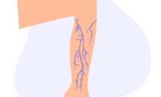 Varicose,Veins,Concept.,Swelling,And,Pain,In,Female,Legs.,Vascular