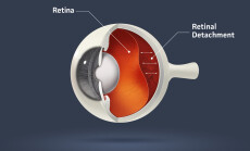 Human,Eye,-,Retinal,Detachment,(eye,Disease)