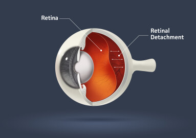 Human,Eye,-,Retinal,Detachment,(eye,Disease)