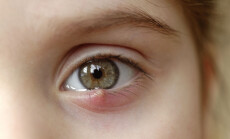 Close-up,Of,A,Child's,Eye,Stye.,Ophthalmic,Hordeolum,Disease.