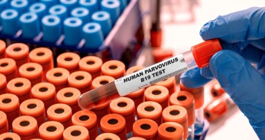 Human,Parvovirus,B19,Test,Tube,With,Blood,Sample,In,Infection