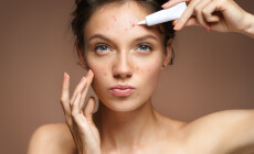 Teen,Girl,With,Problem,Skin,Applying,Treatment,Cream,On,Beige
