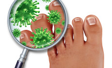 Foot,Fungus,Disease,With,A,Close,Up,Of,The,Human