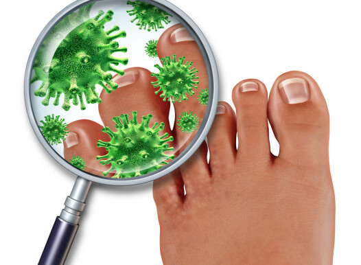 Foot,Fungus,Disease,With,A,Close,Up,Of,The,Human