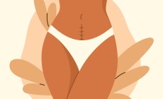 Cesarean,Scar.,Stitches,After,Caesarean,Section,On,Female,Belly.,C-section,
