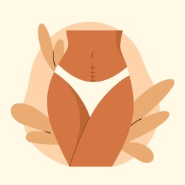 Cesarean,Scar.,Stitches,After,Caesarean,Section,On,Female,Belly.,C-section,