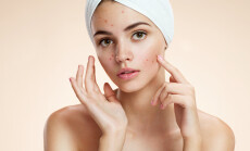 Scowling,Girl,Pointing,At,Her,Acne,With,A,Towel,On