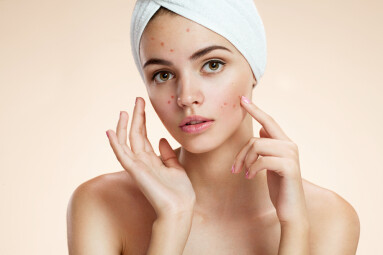 Scowling,Girl,Pointing,At,Her,Acne,With,A,Towel,On