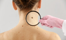 Dermatologist,Examining,Moles,Of,Patient,On,Light,Background