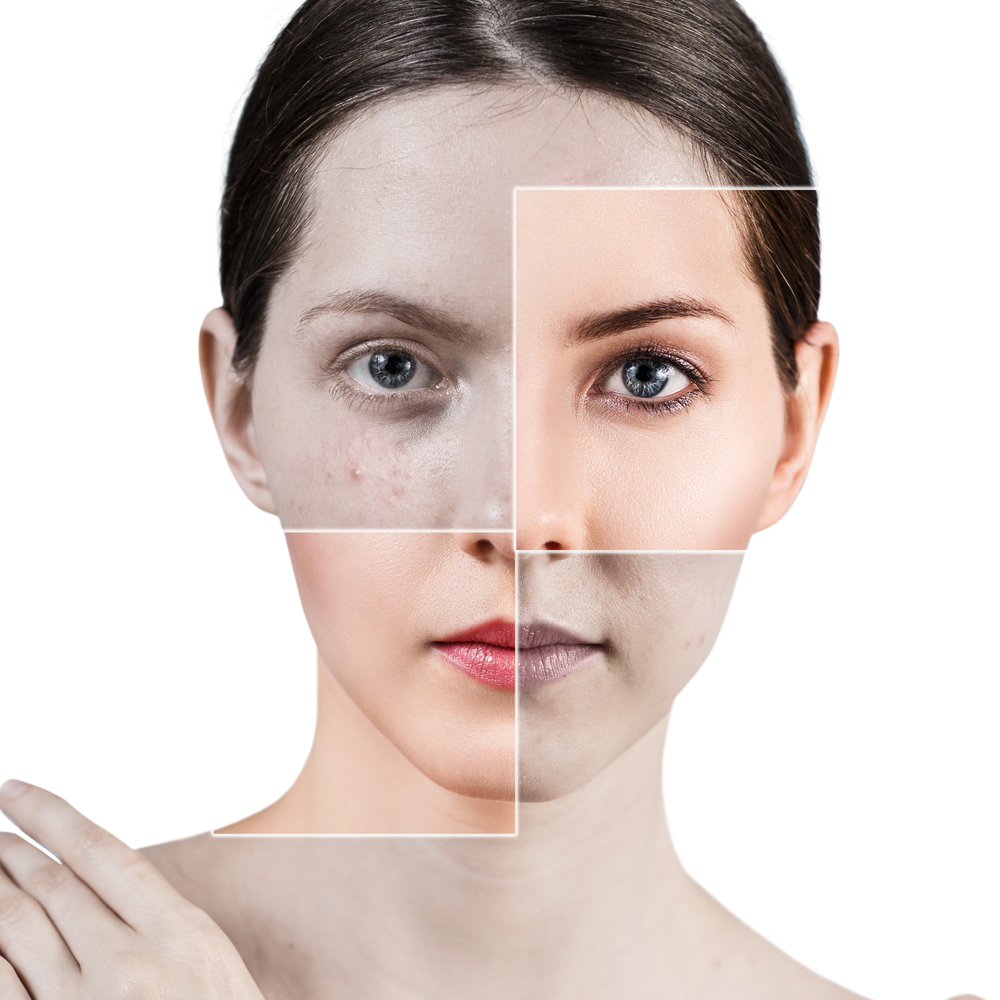Square,Parts,Shows,Skin,After,Treatment.