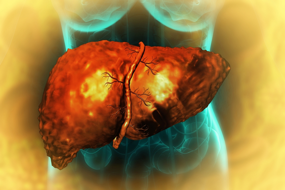 Liver,Damage,Such,As,Fatty,Liver,,Fibrosis,,Cirrhosis,,And,Liver