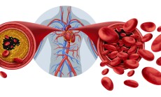 Atherosclerosis,Medical,Condition,As,Blocked,Human,Artery,Concept,And,Restricted