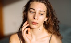 Young,Woman,With,Acne,Problem.,Dermatology,,Cosmetology,,Skin,Care.,Natural