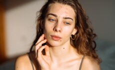Young,Woman,With,Acne,Problem.,Dermatology,,Cosmetology,,Skin,Care.,Natural