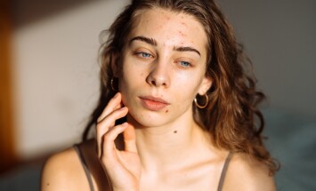 Young,Woman,With,Acne,Problem.,Dermatology,,Cosmetology,,Skin,Care.,Natural