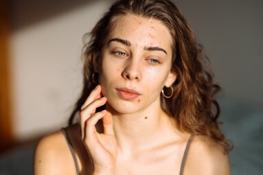 Young,Woman,With,Acne,Problem.,Dermatology,,Cosmetology,,Skin,Care.,Natural